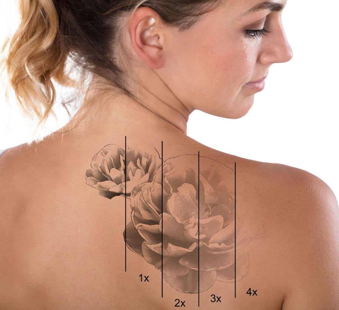 laser tatto removal near portsmouth